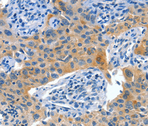 Immunohistochemistry of paraffin-embedded Human lung cancer using Placental Alkaline Phosphatase Polyclonal Antibody at dilution of 1:60