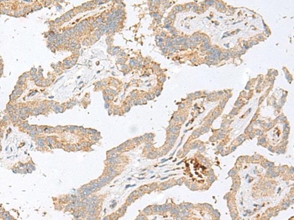 Immunohistochemistry of paraffin-embedded Human thyroid cancer tissue  using HBG1:HBG2 Polyclonal Antibody at dilution of 1:100(?200)