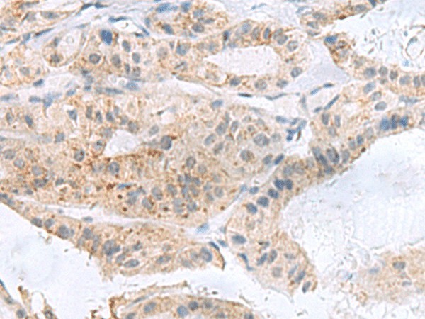 Immunohistochemistry of paraffin-embedded Human thyroid cancer tissue  using PHLDA3 Polyclonal Antibody at dilution of 1:110(?200)