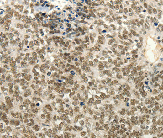 Immunohistochemistry of paraffin-embedded Human ovarian cancer tissue using Frizzled 10 Polyclonal Antibody at dilution 1:50