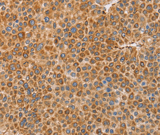 Immunohistochemistry of paraffin-embedded Human liver cancer tissue using BRS3 Polyclonal Antibody at dilution 1:30