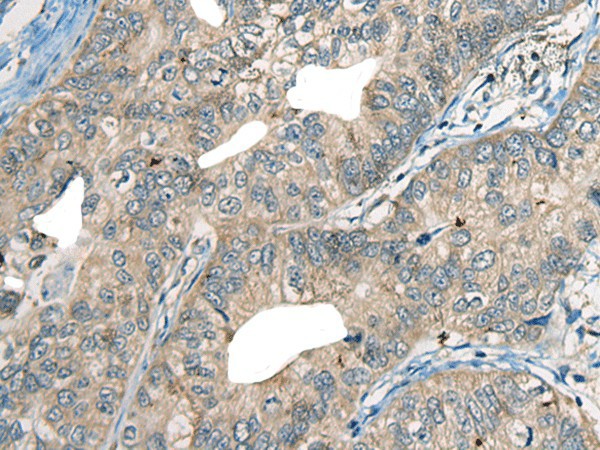 Immunohistochemistry of paraffin-embedded Human gastric cancer tissue  using CDADC1 Polyclonal Antibody at dilution of 1:60(?200)