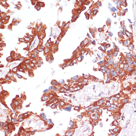 Immunohistochemistry of paraffin-embedded Human lung cancer using Caspase-9 Polyclonal Antibody at dilution of 1:100 (40x lens).