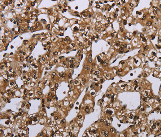 Immunohistochemistry of paraffin-embedded Human prostate cancer tissue using MEIS1 Polyclonal Antibody at dilution 1:40