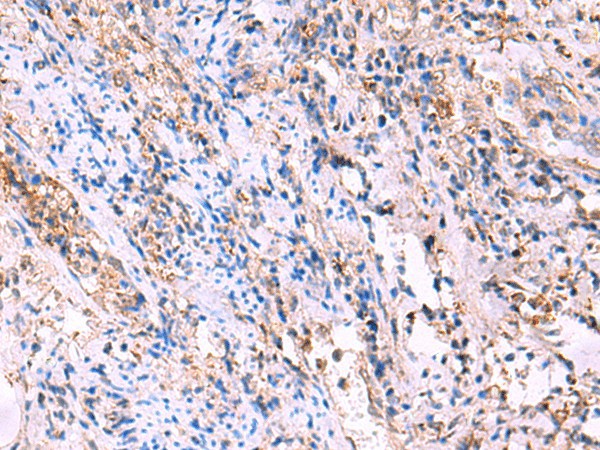 Immunohistochemistry of paraffin-embedded Human cervical cancer tissue  using FUCA2 Polyclonal Antibody at dilution of 1:70(?200)