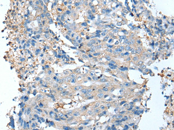 Immunohistochemistry of paraffin-embedded Human colorectal cancer tissue  using DCX Polyclonal Antibody at dilution of 1:35(?200)