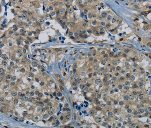 Immunohistochemistry of paraffin-embedded Human breast cancer tissue using PIK3CG Polyclonal Antibody at dilution 1:50