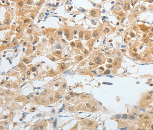 Immunohistochemistry of paraffin-embedded Human liver cancer tissue using BPIFB2 Polyclonal Antibody at dilution 1:45