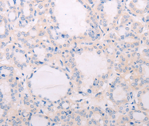 Immunohistochemistry of paraffin-embedded Human thyroid cancer tissue using TSHR Polyclonal Antibody at dilution 1:50