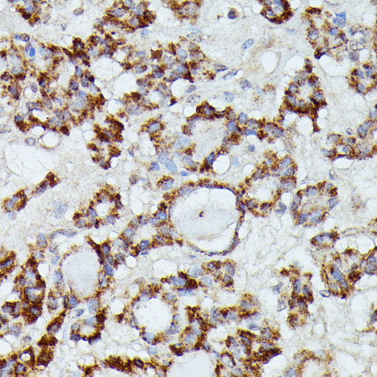 Immunohistochemistry of paraffin-embedded Human thyroid cancer using MANBA Polyclonal Antibody at dilution of 1:100 (40x lens).