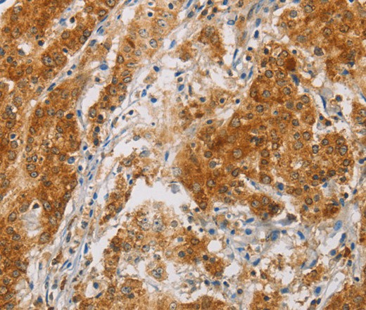 Immunohistochemistry of paraffin-embedded Human gasrtic cancer tissue using CENPE Polyclonal Antibody at dilution 1:50