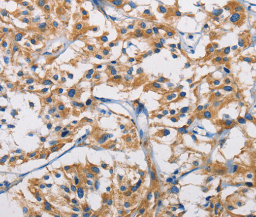 Immunohistochemistry of paraffin-embedded Human thyroid cancer tissue using HK1 Polyclonal Antibody at dilution 1:50