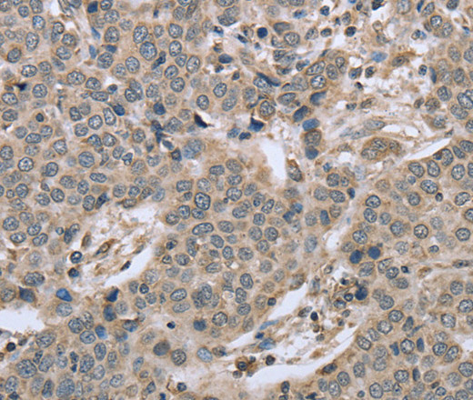 Immunohistochemistry of paraffin-embedded Human liver cancer using RHEB Polyclonal Antibody at dilution of 1:40