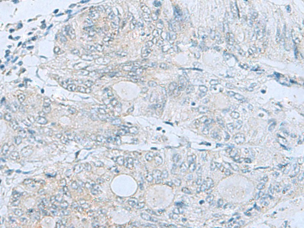 Immunohistochemistry of paraffin-embedded Human colorectal cancer tissue  using MGME1 Polyclonal Antibody at dilution of 1:50(?200)