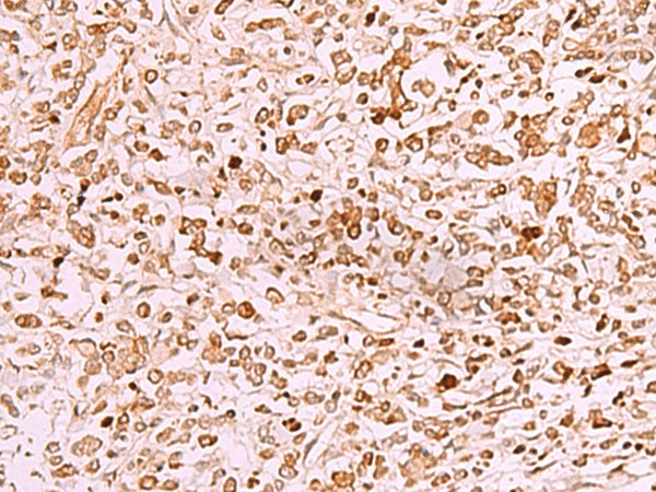 Immunohistochemistry of paraffin-embedded Human gastric cancer tissue  using SAMSN1 Polyclonal Antibody at dilution of 1:50(?200)