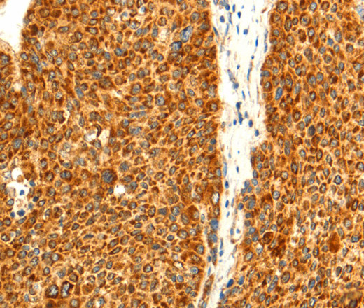 Immunohistochemistry of paraffin-embedded Human liver cancer using DIABLO Polyclonal Antibody at dilution of 1:50