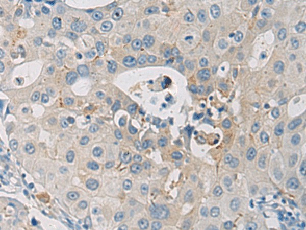 Immunohistochemistry of paraffin-embedded Human breast cancer tissue  using WFDC3 Polyclonal Antibody at dilution of 1:40(?200)