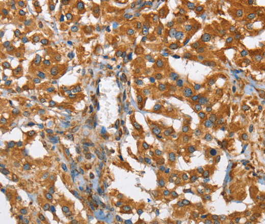 Immunohistochemistry of paraffin-embedded Human thyroid cancer using BCAP31 Polyclonal Antibody at dilution of 1:30