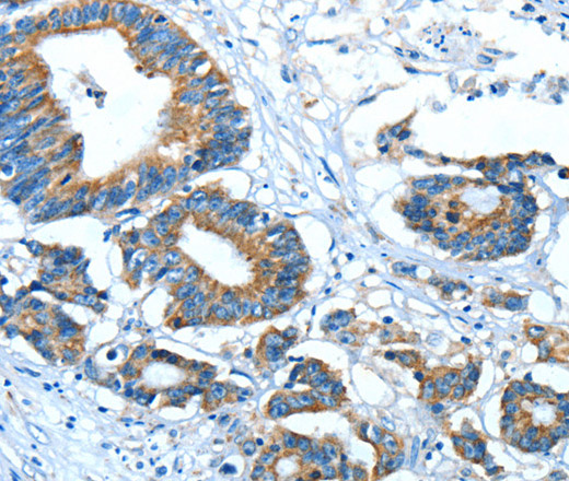 Immunohistochemistry of paraffin-embedded Human colon cancer using GLRA1 Polyclonal Antibody at dilution of 1:30