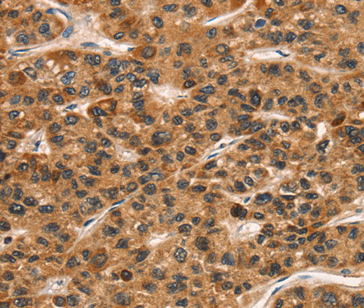 Immunohistochemistry of paraffin-embedded Human liver cancer tissue using CD159a/c Polyclonal Antibody at dilution 1:30