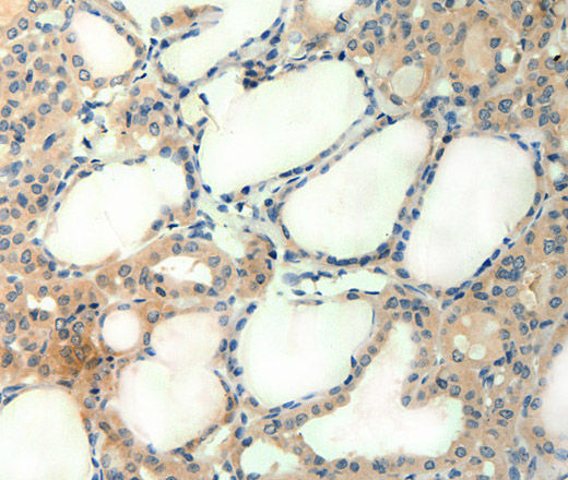 Immunohistochemistry of paraffin-embedded Human thyroid cancer tissue using AGRN Polyclonal Antibody at dilution of 1:50