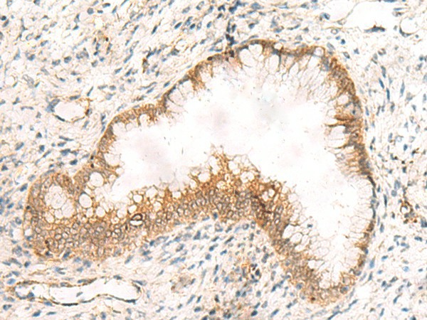 Immunohistochemistry of paraffin-embedded Human cervical cancer tissue  using ZNF397 Polyclonal Antibody at dilution of 1:45(?200)