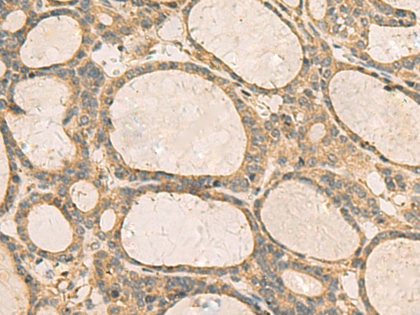 Immunohistochemistry of paraffin-embedded Human thyroid cancer tissue  using CXCL1 Polyclonal Antibody at dilution of 1:35(?200)