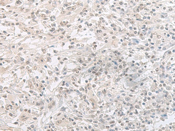 Immunohistochemistry of paraffin-embedded Human liver cancer tissue  using ORC1 Polyclonal Antibody at dilution of 1:65(?200)