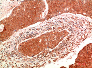 Immunohistochemistry of paraffin-embedded Human breast carcinoma tissue using JAK2 Monoclonal Antibody at dilution of 1:200.