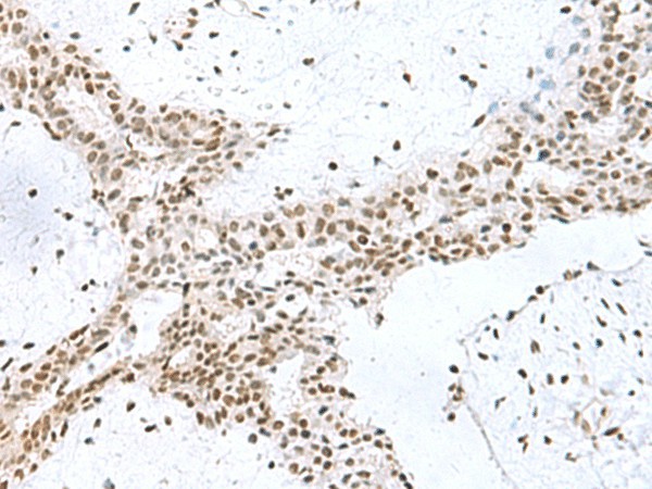 Immunohistochemistry of paraffin-embedded Human breast cancer tissue  using PUM3 Polyclonal Antibody at dilution of 1:80(?200)