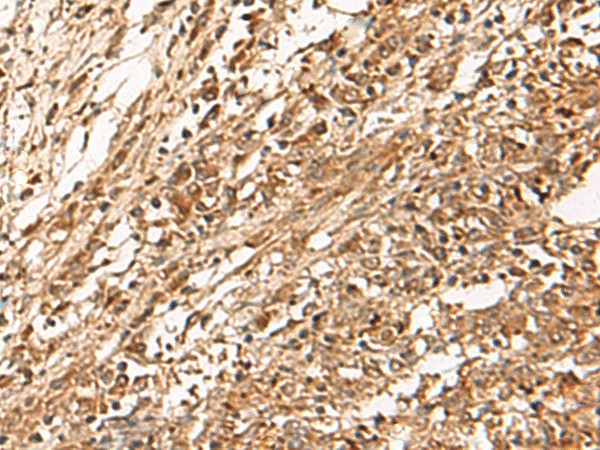 Immunohistochemistry of paraffin-embedded Human liver cancer tissue  using ZBTB43 Polyclonal Antibody at dilution of 1:90(?200)