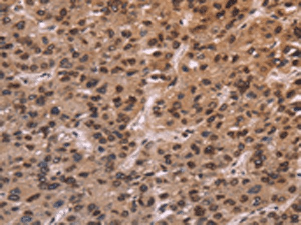 Immunohistochemistry of paraffin-embedded Human liver cancer tissue  using LMNB1 Polyclonal Antibody at dilution of 1:60(?200)