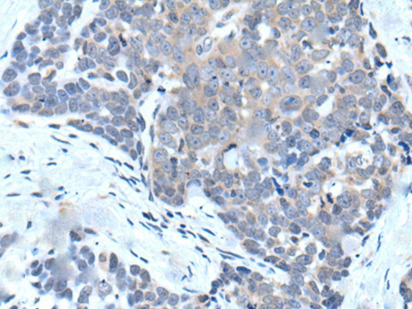 Immunohistochemistry of paraffin-embedded Human thyroid cancer tissue  using VPS35 Polyclonal Antibody at dilution of 1:25(?200)