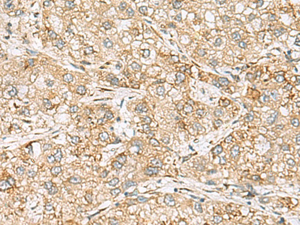 Immunohistochemistry of paraffin-embedded Human liver cancer tissue  using SH3GL2 Polyclonal Antibody at dilution of 1:80(?200)