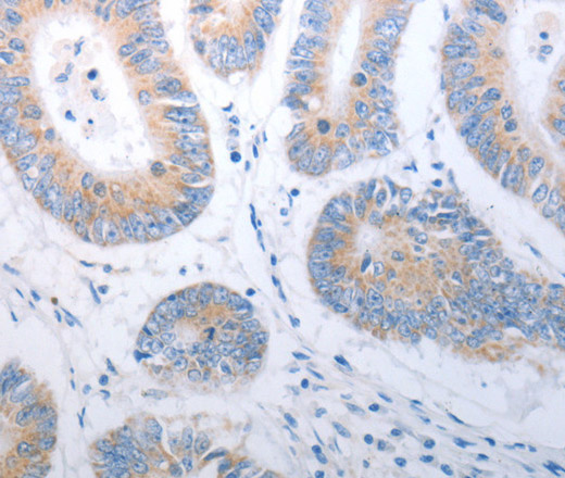 Immunohistochemistry of paraffin-embedded Human colon cancer using PAK1 Polyclonal Antibody at dilution of 1:40