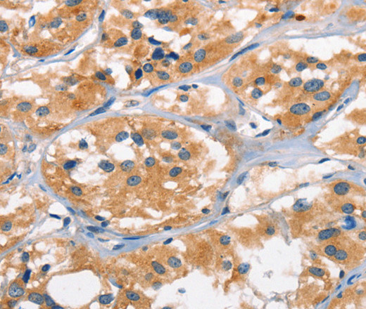 Immunohistochemistry of paraffin-embedded Human thyroid cancer tissue using AHR Polyclonal Antibody at dilution 1:50