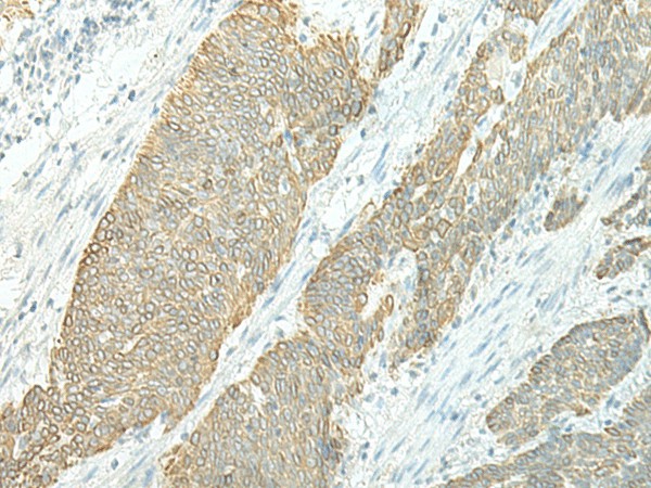 Immunohistochemistry of paraffin-embedded Human esophagus cancer tissue  using ETAA1 Polyclonal Antibody at dilution of 1:25(?200)