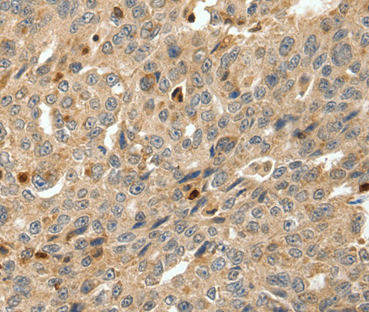 Immunohistochemistry of paraffin-embedded Human ovarian cancer tissue using S100A4 Polyclonal Antibody at dilution 1:80