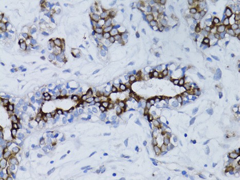 Immunohistochemistry of paraffin-embedded human breast cancer using BRCA1 Polyclonal Antibody at dilution of 1:100 (40x lens).Perform microwave antigen retrieval with 10 mM PBS buffer pH 7.2 before commencing with IHC staining protocol.