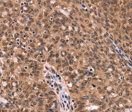 Immunohistochemistry of paraffin-embedded Human ovarian cancer tissue using ESRRB Polyclonal Antibody at dilution 1:40