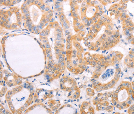 Immunohistochemistry of paraffin-embedded Human thyroid cancer tissue using pVHL Polyclonal Antibody at dilution 1:40