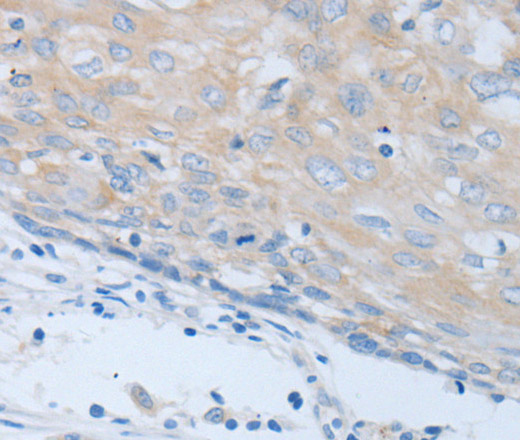 Immunohistochemistry of paraffin-embedded Human cervical cancer using CHRNA7 Polyclonal Antibody at dilution of 1:40