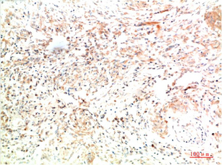 Immunohistochemistry of paraffin-embedded Human lung carcinoma tissue using COL2A1 Monoclonal Antibody at dilution of 1:200.