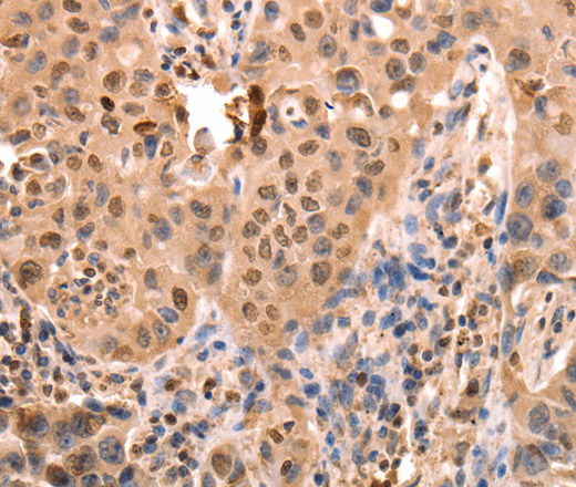 Immunohistochemistry of paraffin-embedded Human lung cancer using ACO2 Polyclonal Antibody at dilution of 1:30