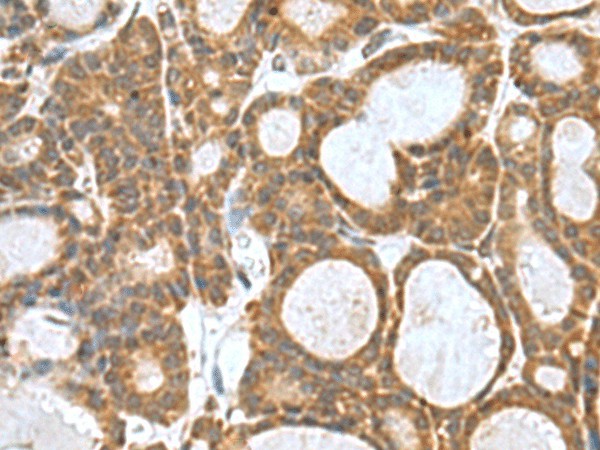 Immunohistochemistry of paraffin-embedded Human thyroid cancer tissue  using KANSL1L Polyclonal Antibody at dilution of 1:80(?200)