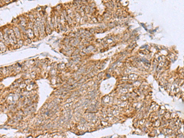 Immunohistochemistry of paraffin-embedded Human colorectal cancer tissue  using HCCS Polyclonal Antibody at dilution of 1:60(?200)