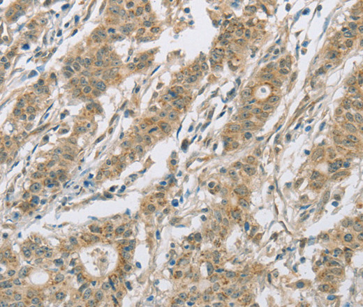 Immunohistochemistry of paraffin-embedded Human gastric cancer tissue using CYP2C9 Polyclonal Antibody at dilution 1:50