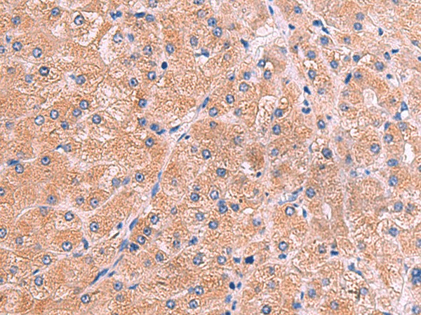 Immunohistochemistry of paraffin-embedded Human liver cancer tissue  using ZAP70 Polyclonal Antibody at dilution of 1:60(?200)