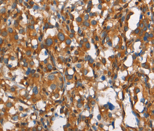 Immunohistochemistry of paraffin-embedded Human thyroid cancer tissue using CEACAM3 Polyclonal Antibody at dilution 1:30