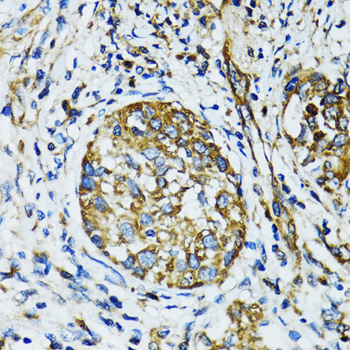 Immunohistochemistry of paraffin-embedded Human lung cancer using ATG7 Polyclonal Antibody at dilution of 1:100 (40x lens).